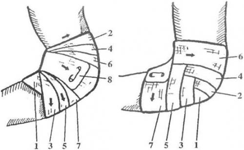Черепашья сходящаяся и расходящаяся повязка. Сходящаяся и расходящаяся черепашья повязка на локоть и колено