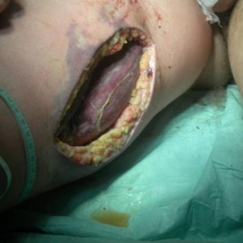 Бинт эластичный на плечевой сустав. Эластичные бинты. Дань уходящему времени или повседневная необходимость? 06