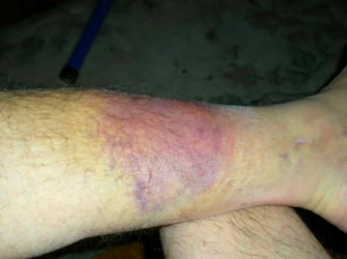 Гипсовый метод лечения перелома кости. Погружной остеосинтез: применение штифтов 02 Гипсовый метод лечения перелома кости. Погружной остеосинтез: применение штифтов 02