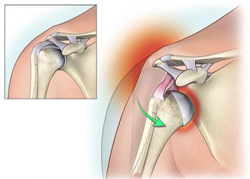 Насколько эффективен бандаж при вывихе плеча. Какой бандаж нужен при переломе плеча? 01