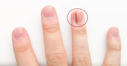 Ониходистрофия ногтей. Что такое ониходистрофия