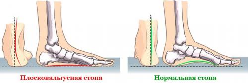 Лечение вальгусной стопы. Что такое плоско-вальгусная деформация стопы