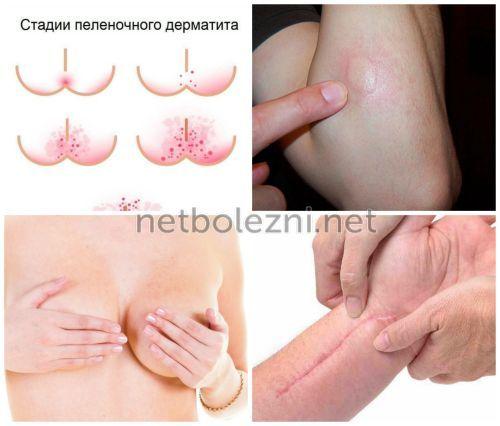 Как правильно обработать рану. Лечение ран и ссадин 08