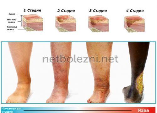Как правильно обработать рану. Лечение ран и ссадин 03