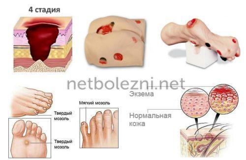 Как правильно обработать рану. Лечение ран и ссадин 06