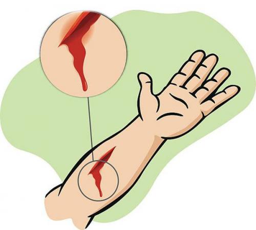 Как правильно обработать рану. Лечение ран и ссадин 10