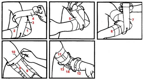 Что такое сходящаяся повязка
