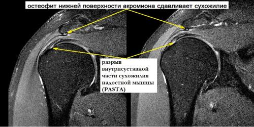 Правильные действия после ушиба плеча. Что нужно знать о ушибе плеча 06