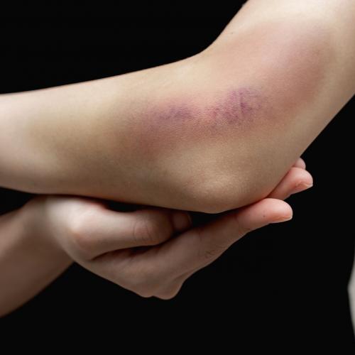 Ушиб локтевого сустава чем мазать. Чем мазать синяк