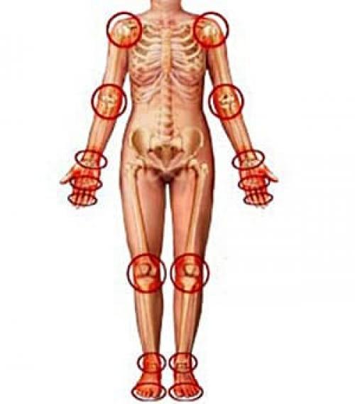 Лечение обострения артроза суставов. Лечение остеоартроза 01