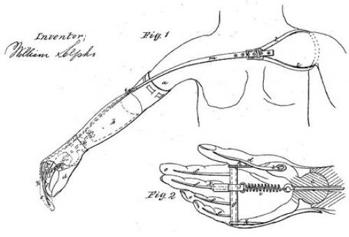 От древних масок до современных протезов: эволюция протезирования 14