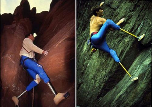 История протезирования от древности до наших дней. Эволюция протезов