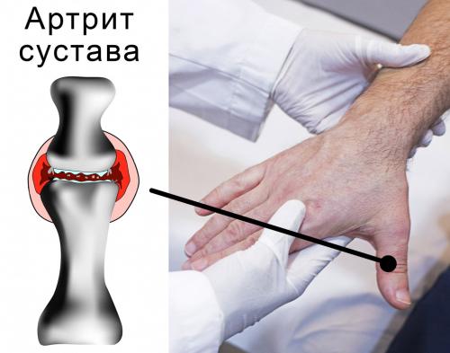 Боль в большом пальце руки. По каким причинам могут болеть суставы пальцев рук? 01