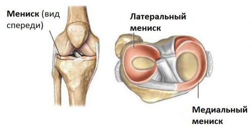 Мениск опасно ли это. Коленный сустав и мениски