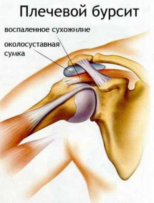 Воспаление мениска мазь. Симптомы бурсита
