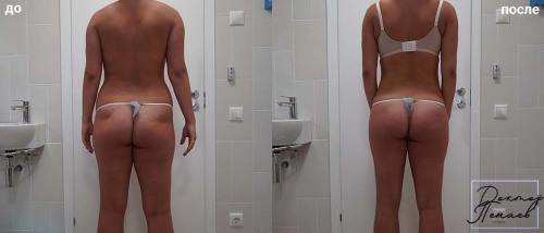 Как сделать кожу упругой на попе. Пластическая хирургия