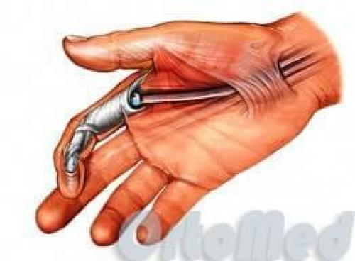 В статье представлена анатомия костей кисти. Кости 01 В статье представлена анатомия костей кисти. Кости 01