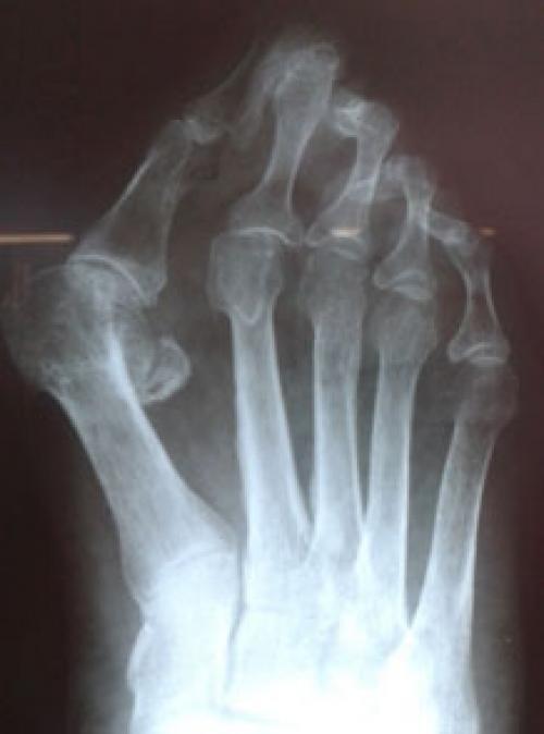 Как выпрямить молоткообразный палец. Другие деформации 2, 3 и 4-го пальцев стопы