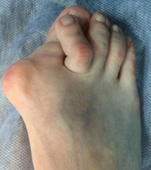 Как выпрямить молоткообразный палец. Другие деформации 2, 3 и 4-го пальцев стопы