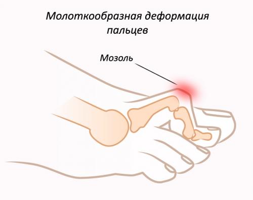 Причины изменения форм пальцев. Деформирующий артроз пальцев рук 09