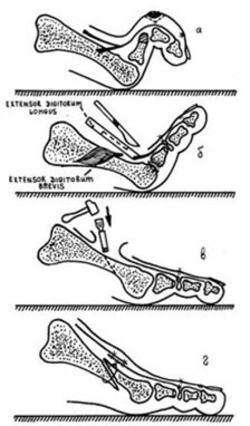 Как выпрямить молоткообразный палец. Другие деформации 2, 3 и 4-го пальцев стопы