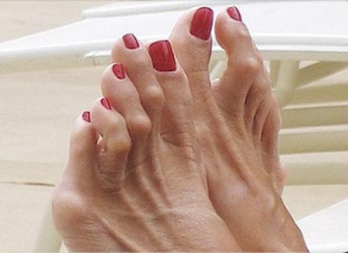 Как выпрямить молоткообразный палец. Другие деформации 2, 3 и 4-го пальцев стопы