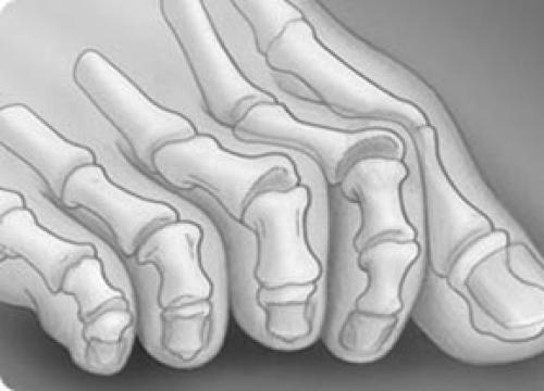 Как выпрямить молоткообразный палец. Другие деформации 2, 3 и 4-го пальцев стопы