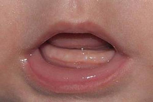 Крепкие кости и зубки у ребенка. Молочные зубы у детей: порядок прорезывания 04