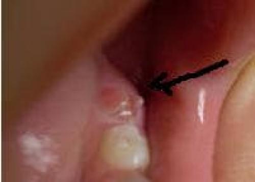 Крепкие кости и зубки у ребенка. Молочные зубы у детей: порядок прорезывания 01