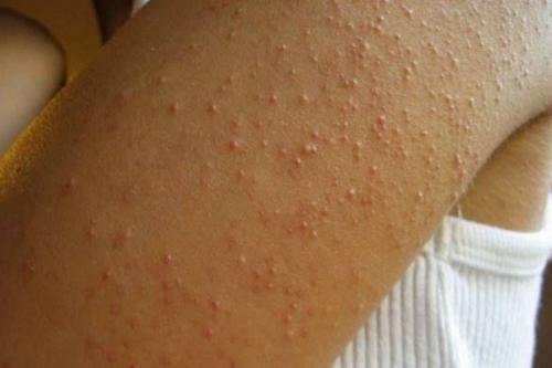 Какие особенности имеет стягивание кожи на коленке в зависимости от типа кожи. Что такое гиперкератоз