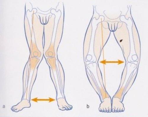 10 упражнений для укрепления стопы. 5 простых упражнений при плоскостопии 01