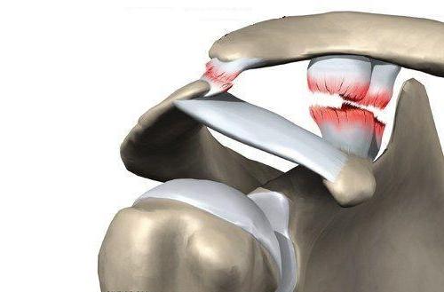 Правое плечо немеет. Болит плечо и немеет рука 06