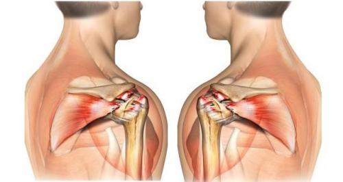 Правое плечо немеет. Болит плечо и немеет рука 04