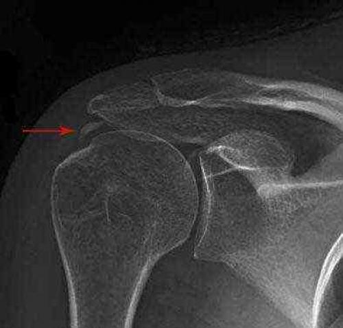 Правое плечо немеет. Болит плечо и немеет рука 07