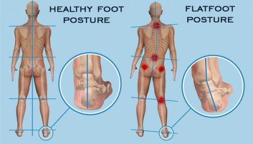 Виды и степени плоскостопия. Определение болезни. Причины заболевания 02 Виды и степени плоскостопия. Определение болезни. Причины заболевания 02