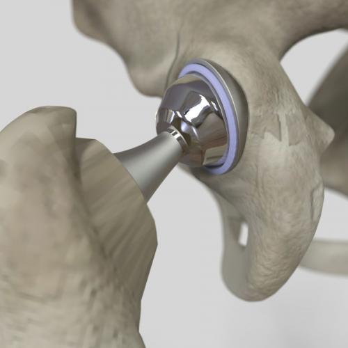 Имплантация искусственных тазобедренных суставов. Виды и элементы протеза тазобедренного сустава