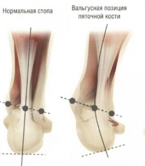 Если растет косточка на ноге. Косточка на ноге (вальгусная деформация) 03