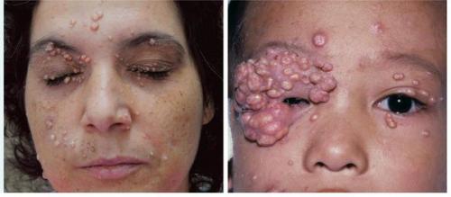 Контагиозный моллюск у детей и взрослых. Контагиозный моллюск 01