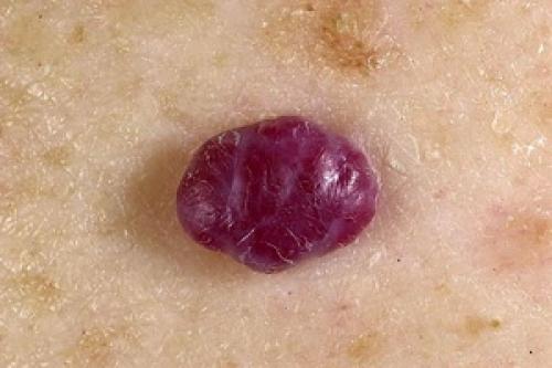 Гемангиома у взрослых. Красные родинки – гемангиомы: причины появления на теле и виды