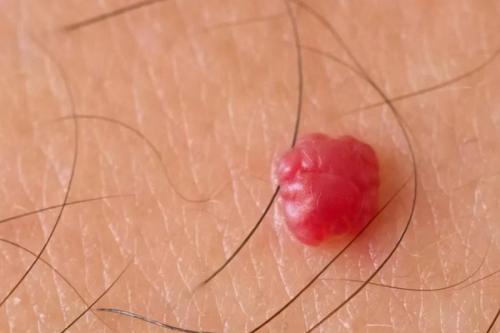 Все о младенческих гемангиомах. Современная стратегия и тактика ведения детей с младенческими гемангиомами 08