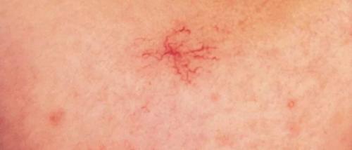 Все о младенческих гемангиомах. Современная стратегия и тактика ведения детей с младенческими гемангиомами 07