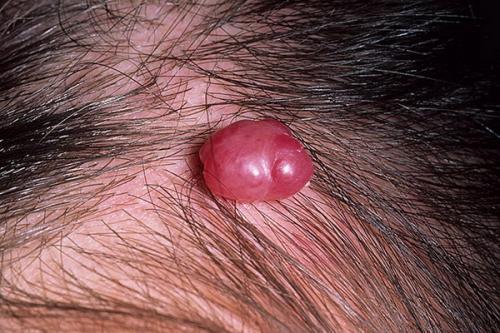 Все о младенческих гемангиомах. Современная стратегия и тактика ведения детей с младенческими гемангиомами 09