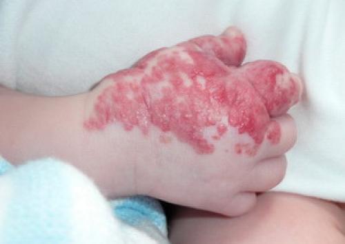 Все о младенческих гемангиомах. Современная стратегия и тактика ведения детей с младенческими гемангиомами 05