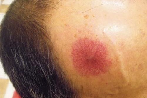 Все о младенческих гемангиомах. Современная стратегия и тактика ведения детей с младенческими гемангиомами 01