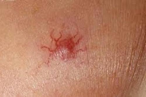 Все о младенческих гемангиомах. Современная стратегия и тактика ведения детей с младенческими гемангиомами 02