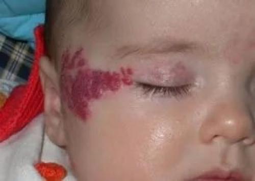 Все о младенческих гемангиомах. Современная стратегия и тактика ведения детей с младенческими гемангиомами 04