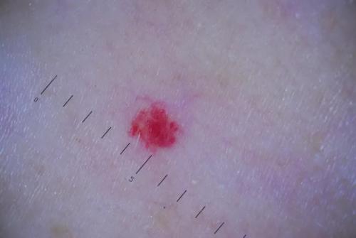 Все о младенческих гемангиомах. Современная стратегия и тактика ведения детей с младенческими гемангиомами 06