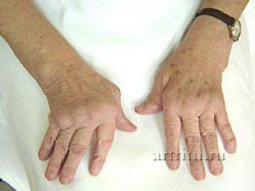 Воспаление суставов пальцев рук+народные средства. Воспаление суставов пальцев рук: лечение препаратами и народными средствами