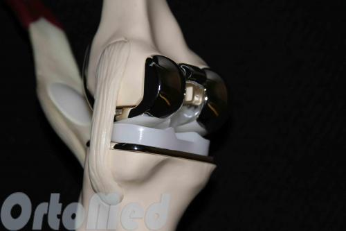 Замена тазобедренного и коленного сустава. Какие бывают эндопротезы? 09 Замена тазобедренного и коленного сустава. Какие бывают эндопротезы? 09