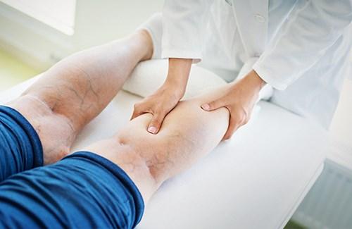 Вздутие вен на руках. Классификация и стадии развития флебита 02